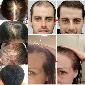 Zencefil Esansiyel Saç Büyüme Yağı Sıvı Anti Saç Dökülmesi Kellik Çare Boost Büyümek Kalın Saç Bakımı Saç Derisi Tedavisi 20 ml